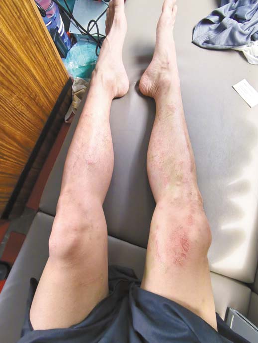陈学冬的腿被水母蜇出很多伤。 网上图片