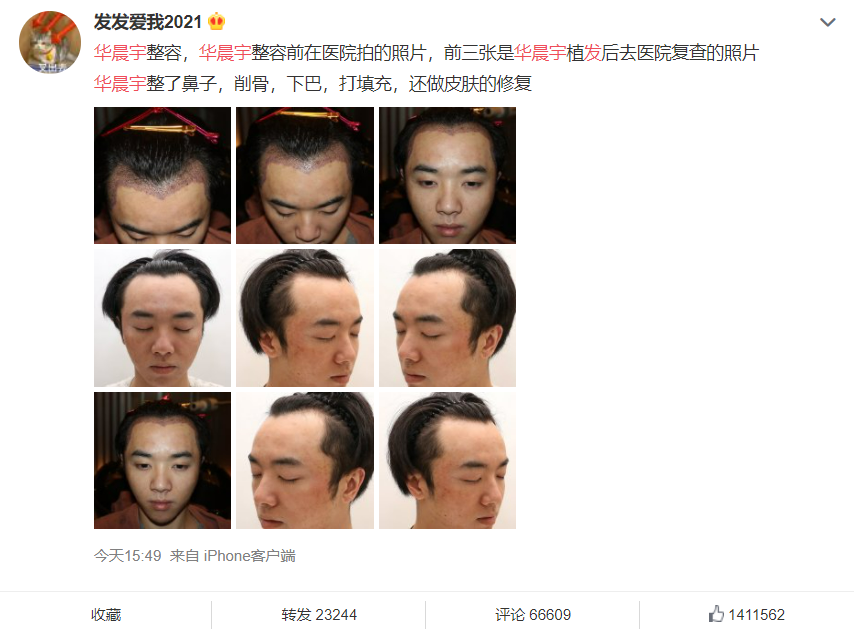 华晨宇被网友踢爆整容，并晒出酷似他的植发前后照片。